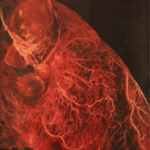 I asked Chris to connect last his week's question on myocardial infarction (coronary blockage) to what happens to an area of the brain if capillaries are destroyed primarily microscopically and widespread in the brain - as in a concussion, but not a contusion.