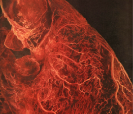 I asked Chris to connect last his week's question on myocardial infarction (coronary blockage) to what happens to an area of the brain if capillaries are destroyed primarily microscopically and widespread in the brain - as in a concussion, but not a contusion.