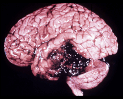 Week 14: Your Brain on Collision Sports