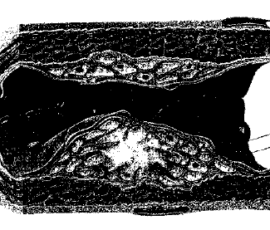 Goal of thesis stated by the authors: "Our starting point is the flow field. The problem of atherosclerosis cannot be seen as a malfunction of the flow of blood alone, or as a misbehaviour of the blood vessel wall alone: there is an interaction between the two. If we want to model the phenomenon, we should not introduce such a separation ourselves.