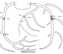Author's excerpt: Oxidized lipids contribute to heart disease by increasing calcium on the arterial wall... and by interrupting blood flow, a major contributor to a heart attack and sudden death. Ed's note. Notice the clogs are at the arterial junctions.