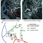 This MRI shows blood flow disruption in the brain, which is where lesions in the brain develop and brain cells die. Doing puzzles and using your brain will not help cell function when blood flow is reduced or cutoff.