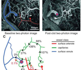 This MRI shows blood flow disruption in the brain, which is where lesions in the brain develop and brain cells die. Doing puzzles and using your brain will not help cell function when blood flow is reduced or cutoff.
